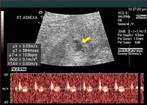 Woman With Heterotopic Pregnancy After Natural Conception