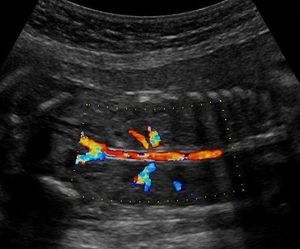 Monolateral double renal artery, Normal variant kidney artery supply