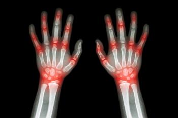 Rheumatoid arthritis| Image Credit: © stockdevil- © stockdevil - stock.adobe.com.