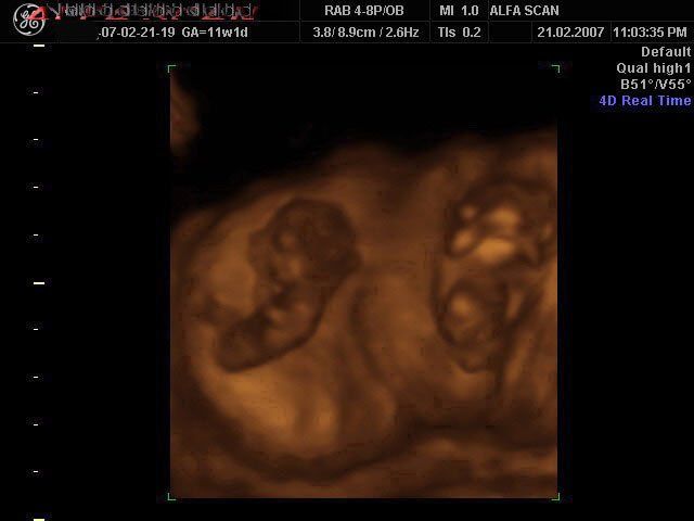 Ultrasound images pregnancy twin 