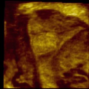 COR Uterus (3D Reconstruction) Endometrial Polyp