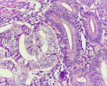 Reproductive factors found to influence endometrial cancer risk | Image Credit: © Chutima - © Chutima - stock.adobe.com.
