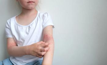 Childhood atopic dermatitis not linked to cardiovascular risk | Image Credit: © marishkaTR - © marishkaTR - stock.adobe.com.