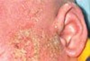 Atopic Dermatitis Superinfection Caused by Staphylococcus sciuri and Enterobacter asburiae