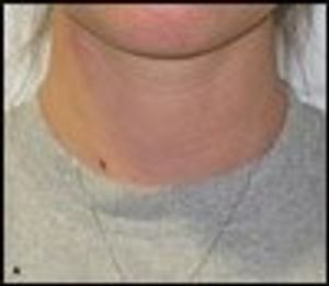 Internal Jugular Phlebectasia