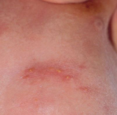 melanotic rash Meyerson naevus Dermatoscopic image of labial melanotic