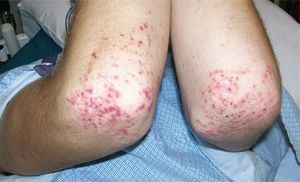 Henoch-Schönlein Purpura in an 18-Year-Old Boy