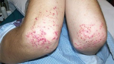 Henoch Schonlein Purpura In An 18 Year Old Boy Henoch Schonlein Purpura In An 18 Year Old Boy