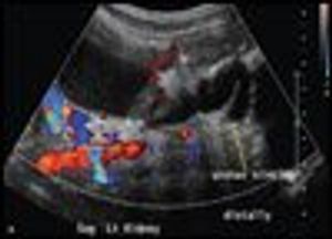 Vesicoureteral Reflux