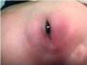 4-Week Old Infant With Unilateral Ocular Pain and Swelling