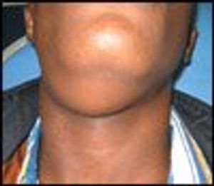 Ranulas in a 14-Year-Old Boy