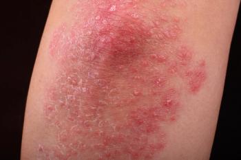 Psoriasis | Image Credit: © quayside - © quayside - stock.adobe.com.
