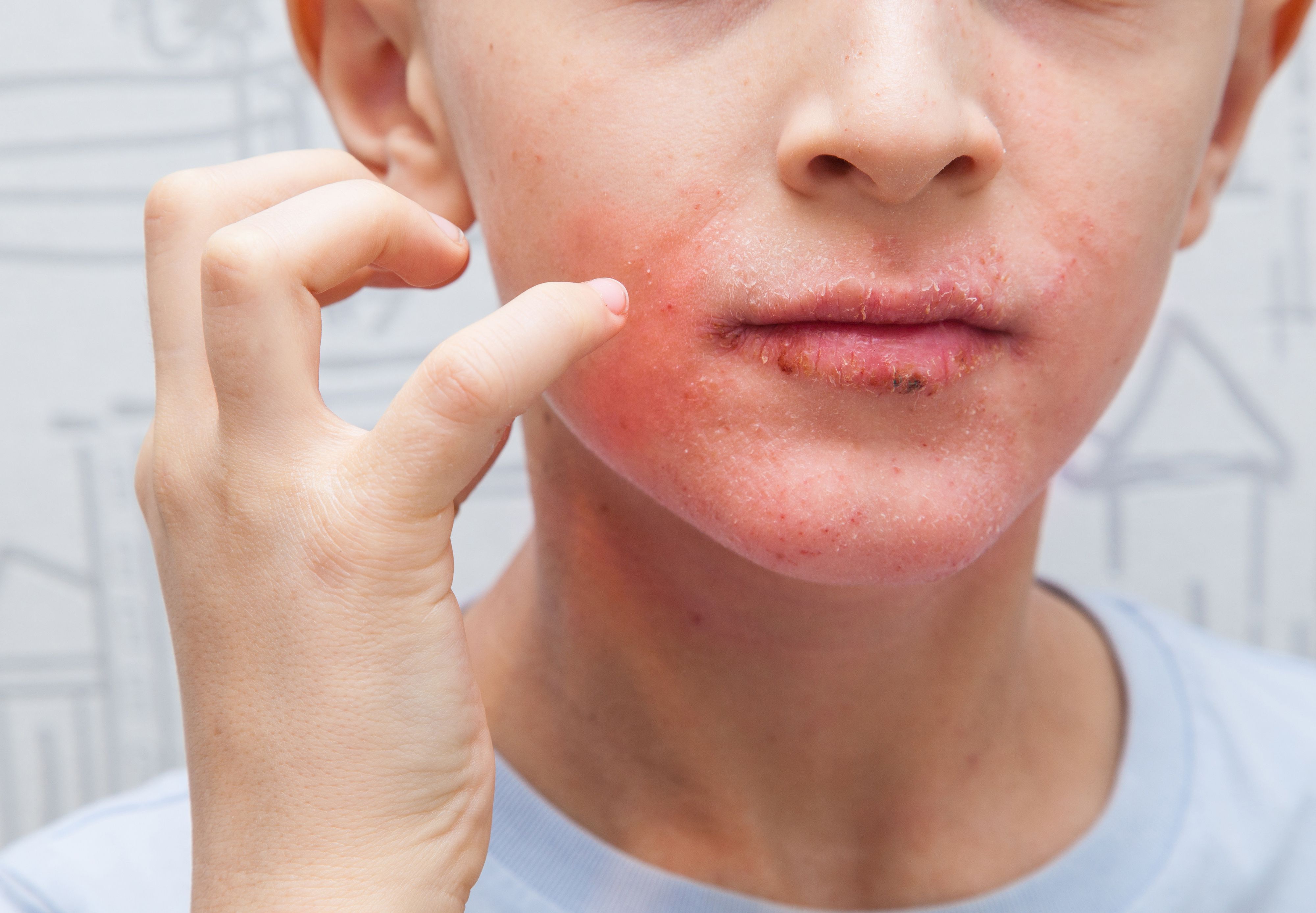 atopic dermatitis