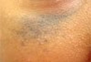 Nevus of Ota