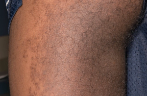 Teenage boy with asymptomatic brown plaque on back of thigh