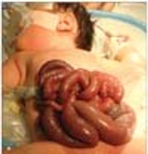 Gastroschisis