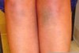 Minocycline Hyperpigmentation