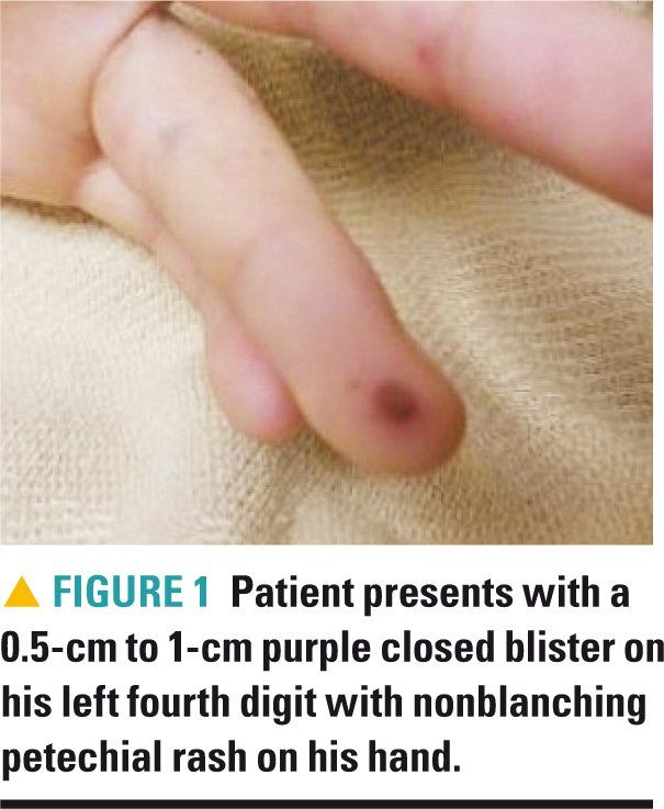 Fever Headache Arthralgias And Rash Fever Headache Arthralgias And Rash