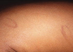 Annular scars with hyperpigmentation