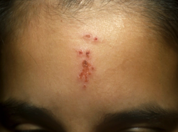A teenage girl with acne lesions on her forehead