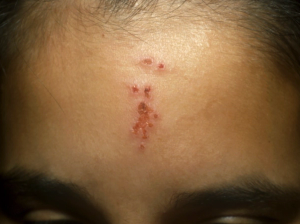 A teenage girl with acne lesions on her forehead