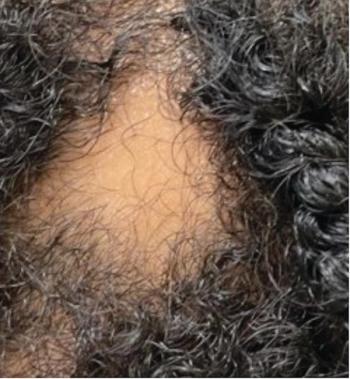 Alopecia in adolescents | Image Credit: Author provided