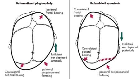 left plagiocephaly