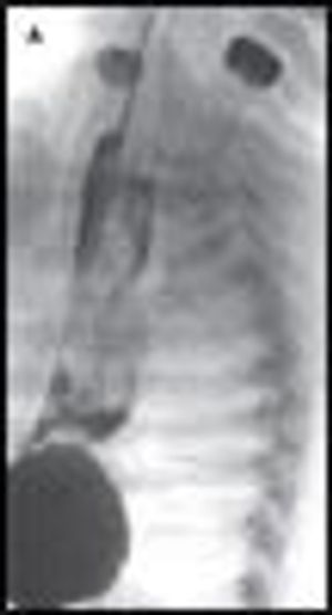 Hematemesis Caused by Esophageal Duplication