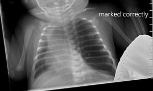 Diagnose this 18-day-old female with apnea, cyanosis, decreased feeding concerns