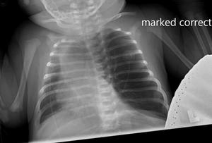 Diagnose this 18-day-old female with apnea, cyanosis, decreased feeding concerns