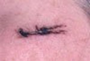 Black-Spot Poison Ivy