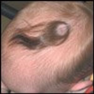 Aplasia Cutis Congenita in an Infant