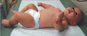 Hypopigmented Patches in Infant With a History of Seizures