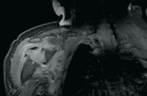 Infant resists moving right shoulder or elbow