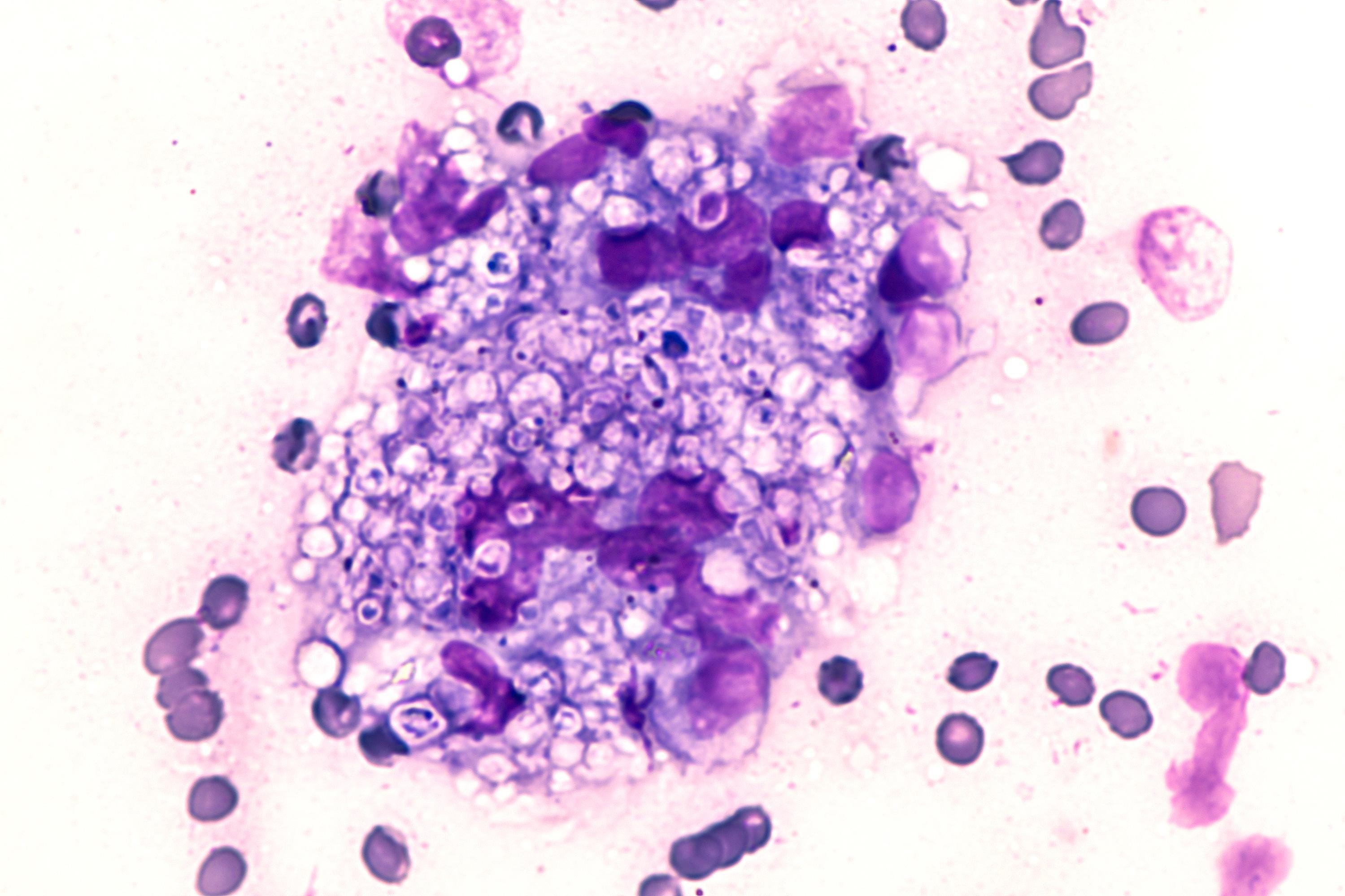 FAQ: What's new in IDSA's histoplasmosis treatment guidance? | Image credit: MedlinePlus
