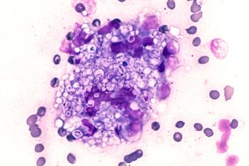 FAQ: What's new in IDSA's histoplasmosis treatment guidance? | Image credit: MedlinePlus