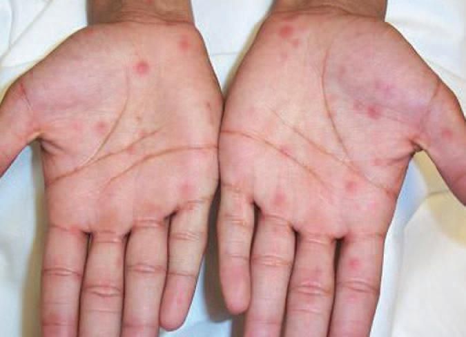 Syphilis Rash Crusts Over Secondary Syphilis Palmar Lesions