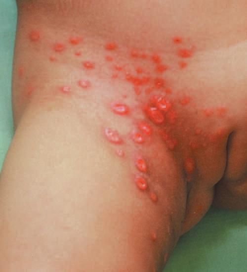 diaper impetigo rash