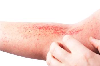 Fall Clinical: Long-term extension data of tapinarof cream 1% for atopic dermatitis | Image Credit: © lial88 - © lial88 - stock.adobe.com.