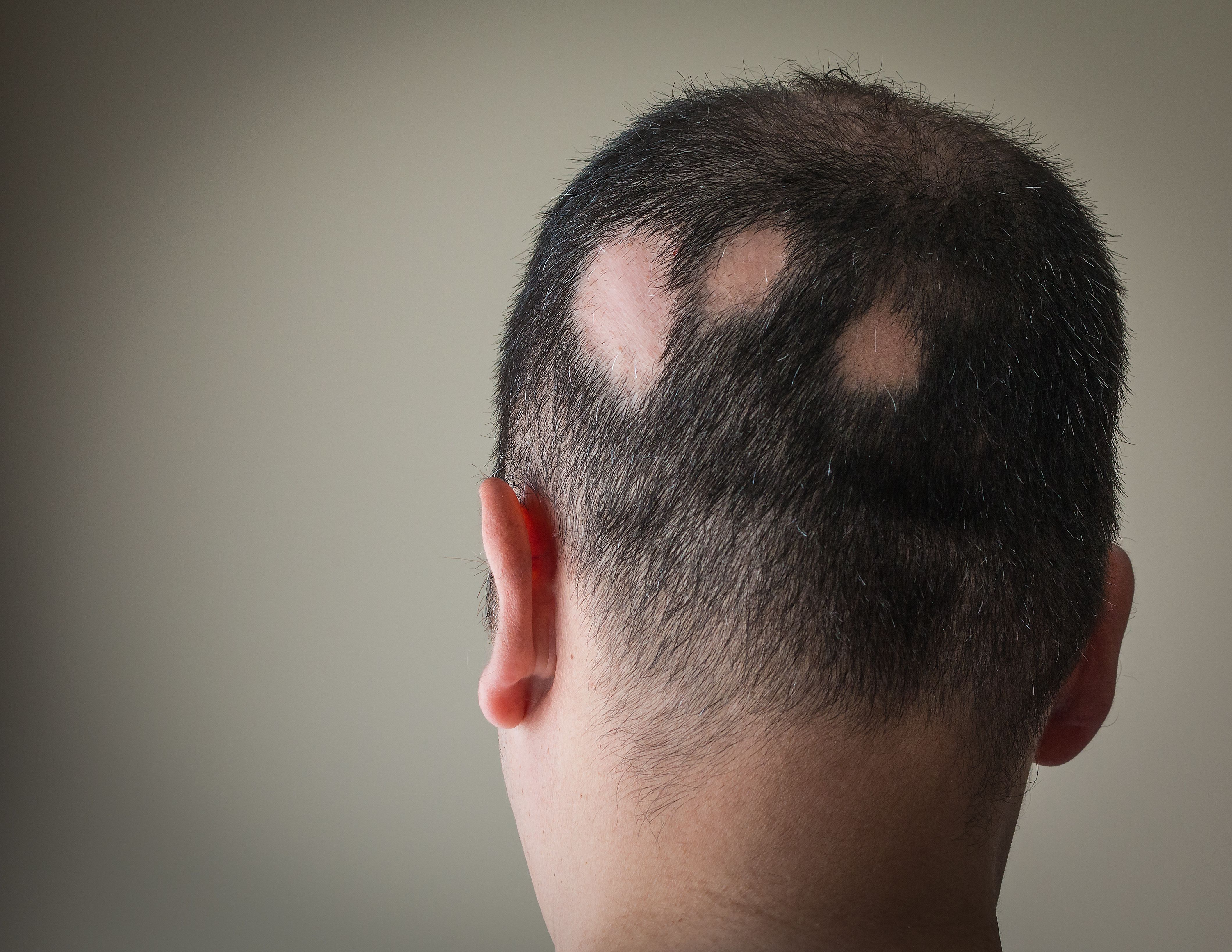 Baricitinib demonstrates sustained hair regrowth in adolescents with alopecia areata | Image Credit: © Alex Papp - © Alex Papp - stock.adobe.com.