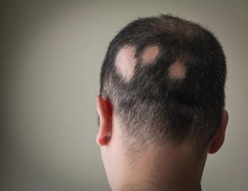 Baricitinib demonstrates sustained hair regrowth in adolescents with alopecia areata | Image Credit: © Alex Papp - © Alex Papp - stock.adobe.com.