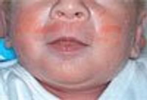 Photoclinic: Asymmetric Crying Facies Syndrome