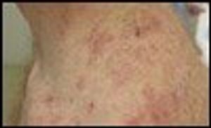 Atypical Dermatitis Herpetiformis