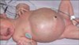 Newborn With Abdominal Mass and Distention