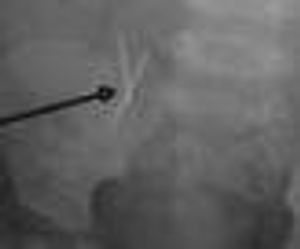 Dislodged Suture Anchor After Gastrostomy