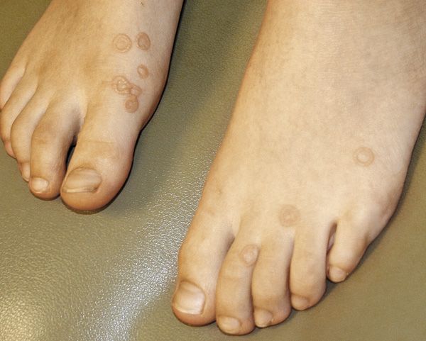 hpv foot warts treatment)