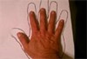 Child Abuse - or Mimic? Suspicious  Bruises: An Old Story with a Twist