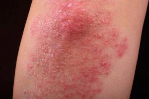stock image of psoriasis