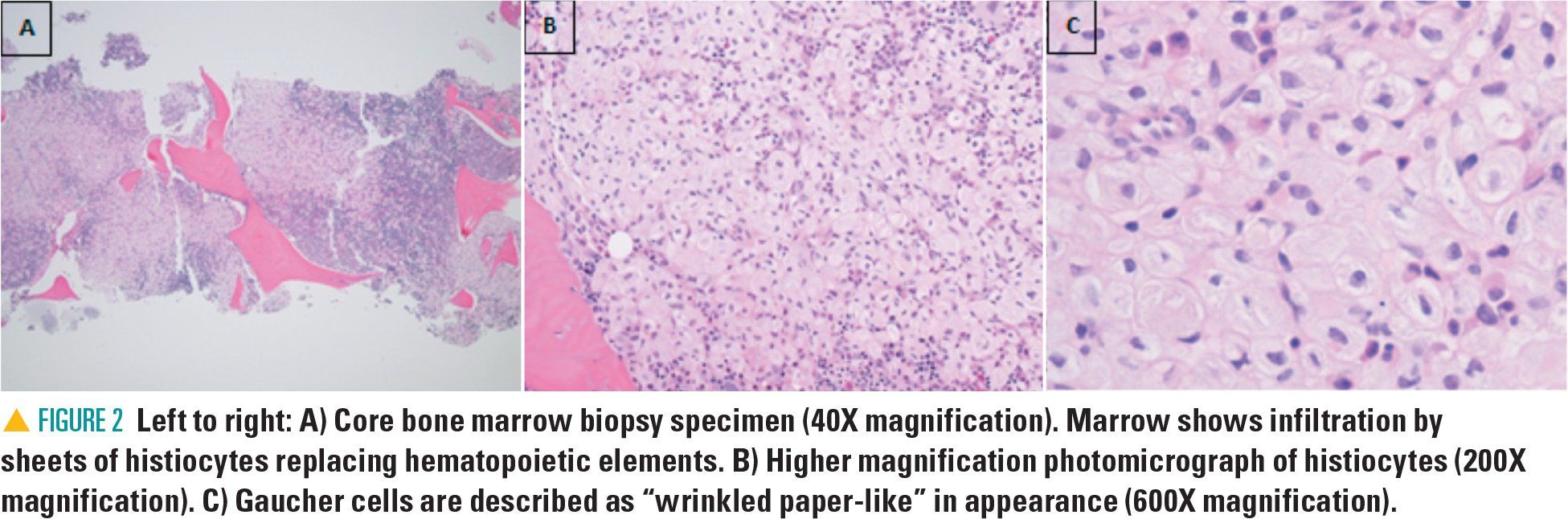 image of core bone marrow biopsy specimen at 40x magnification, 200x magnification, and 600x magnification which shows Gaucher cells