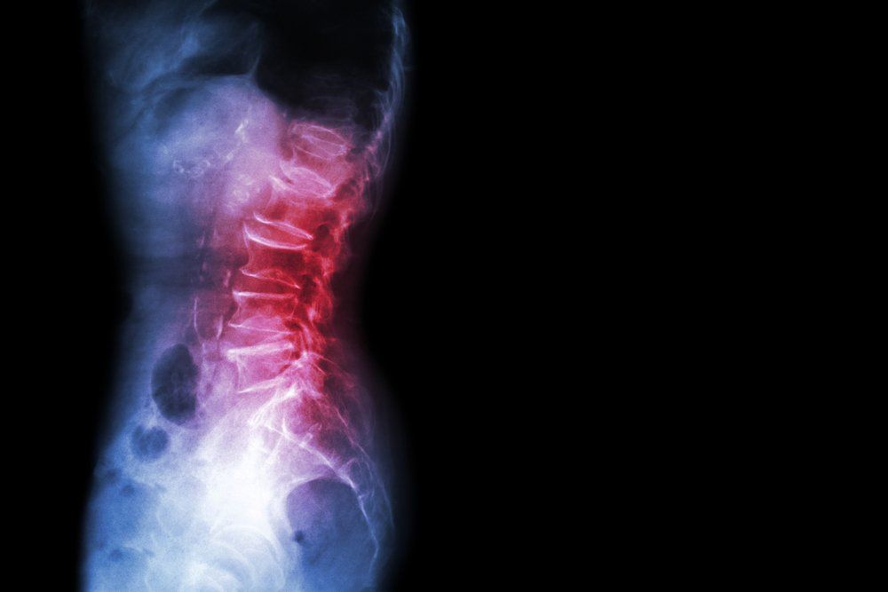 Low Back Pain Linked to Cells in Spinal “Shock Absorbers”